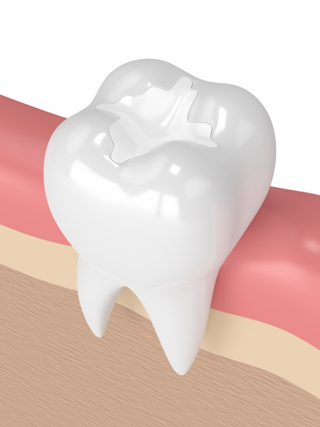 White Fillings
